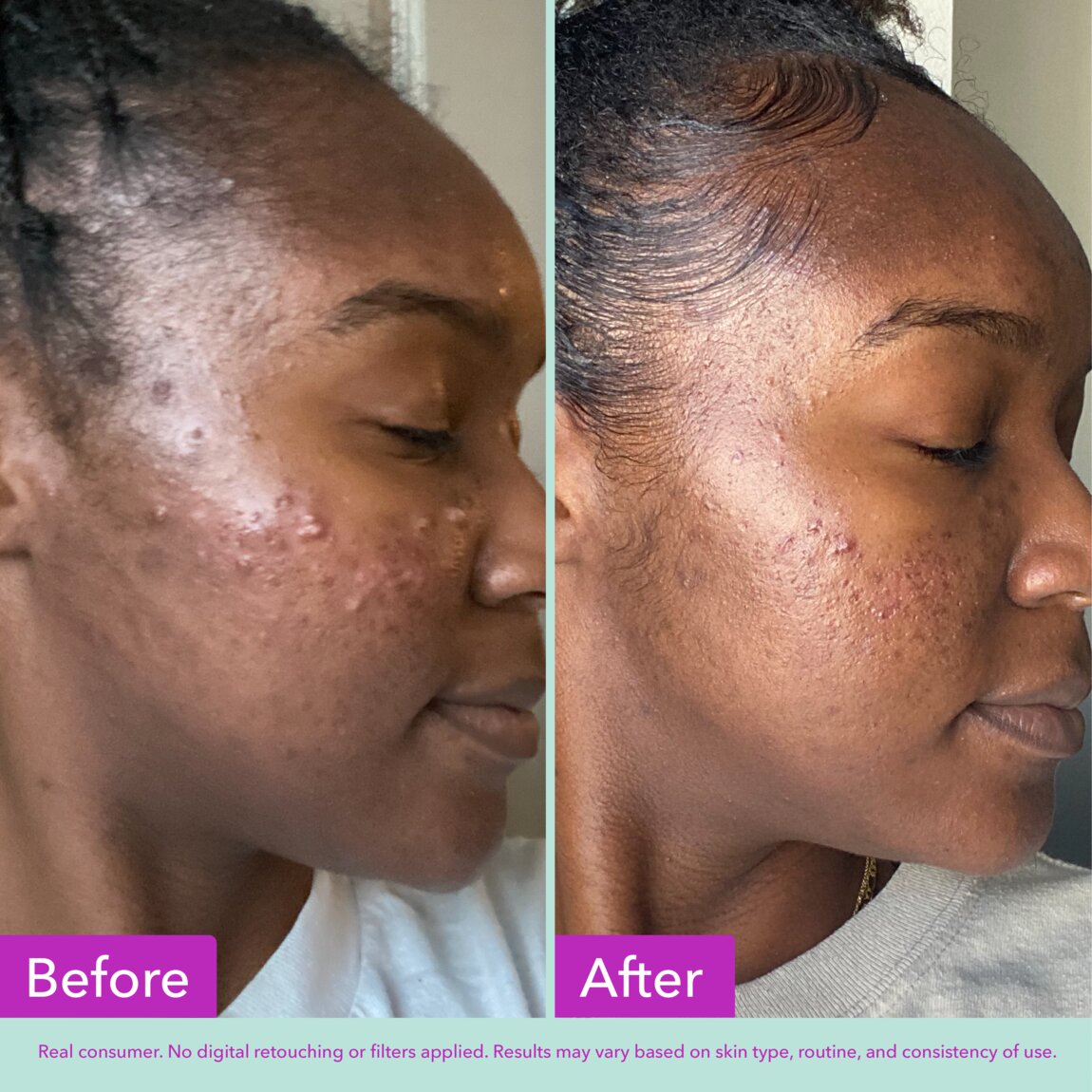 acne-foaming-cleanser-a8 zb_p.jpg