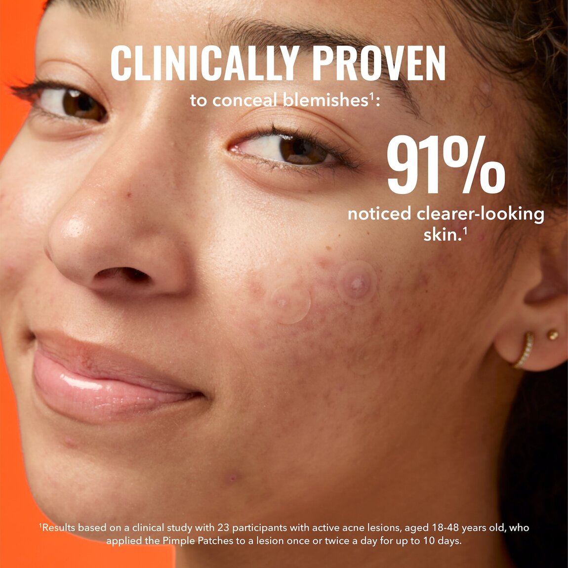 pimple-patches-v3 zb_p.jpg